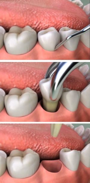 extractie molar de minte