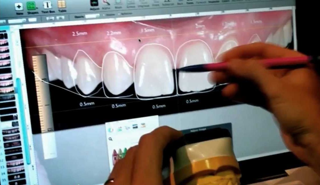 digital smile design