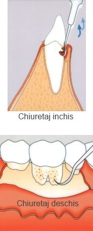 chiuretaj subgingival