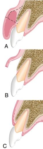 gingivectomie