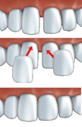 fatete dentare